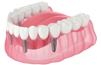 Illustration of an implant denture