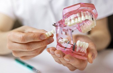 Dentist holding mouth mold and implant bridge