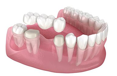 Illustration of traditional bridge being placed on teeth