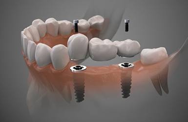Illustration of three-unit dental implant bridge