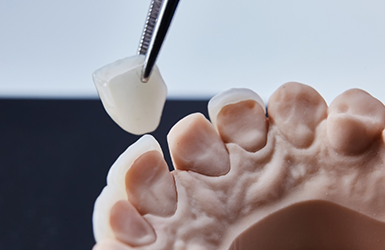 Tweezers placing a veneer over a model of a tooth