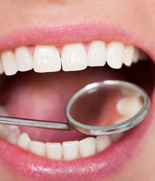 Teeth examined with dental mirror