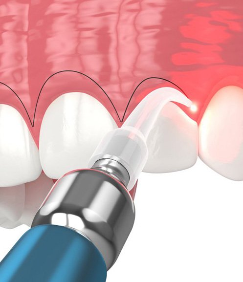 Illustration of gum recontouring process