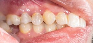 closeup of a person’s missing molar