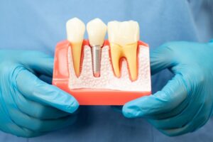 Gloved hands holding dental implant model