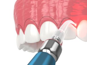 Illustration of laser being used to perform gum recontouring