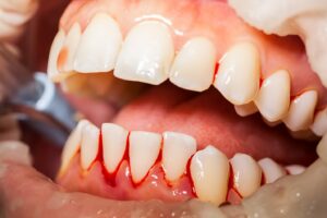 Open mouth showing bleeding between teeth in the gums.